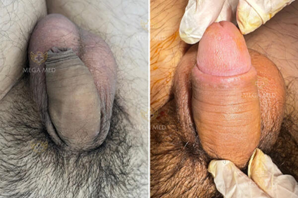 Chữa hẹp bao quy đầu bằng cách cắt bao quy đầu